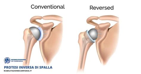 La Protesi Inversa Di Spalla Tutte Le Risposte Alle Vostre Domande