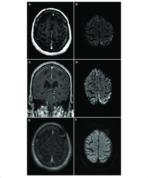 Brain Magnetic Resonance Imaging Mri Rheumatoid Meningitis A Download Scientific Diagram