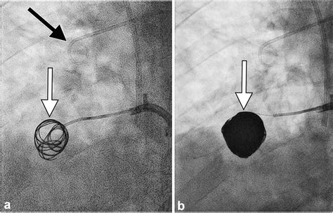 Coil Embolization Of A Pulmonary Varix Via A Transseptal Approach Using