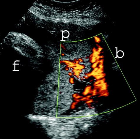 Color Doppler Of Placenta Percreta Same Patient As In Note The Download Scientific Diagram