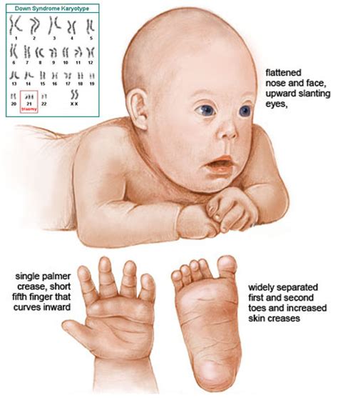 Gallery For > Down Syndrome Baby Hands