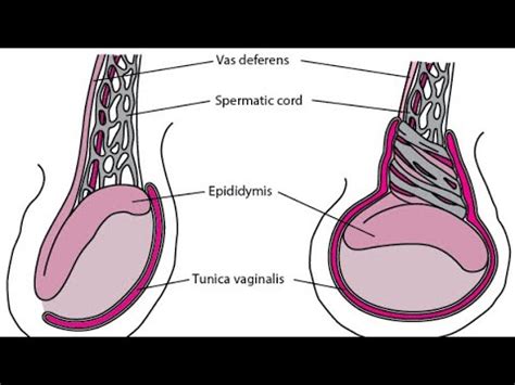 Testicular Emergencies Clear The Mrcs Part A Crash Course Youtube