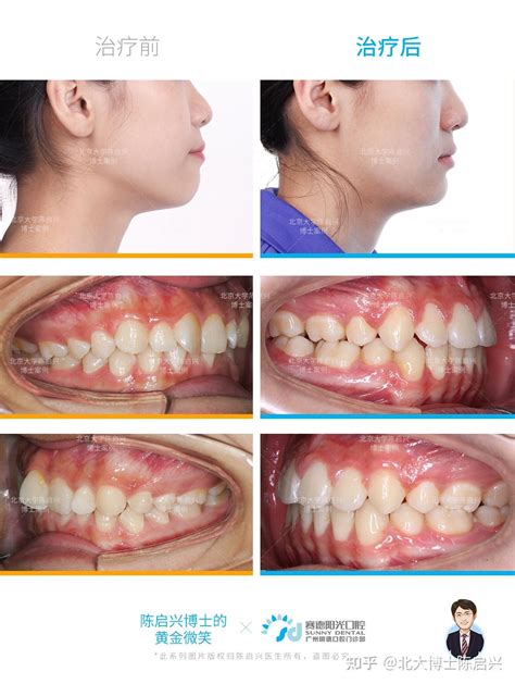 牙齿拥挤门牙扭转深覆合露龈笑矫正案例 知乎