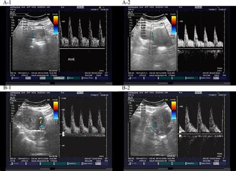 Hemodynamic Parameters Of The Uterine Artery In Patients With Or