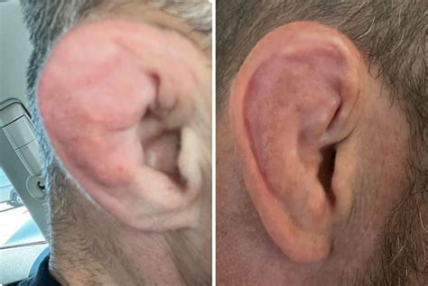 Cauliflower Ear Jiu Jitsu Medicine