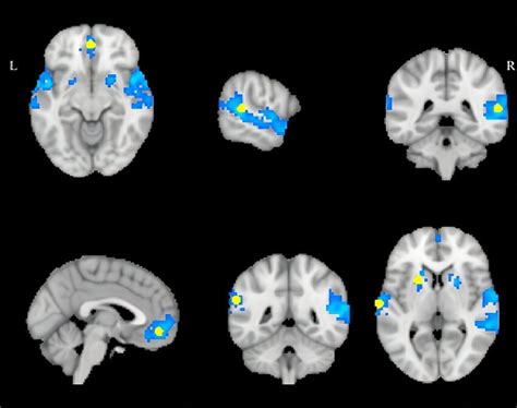 Significant clusters in left and right superior temporal gyrus ...