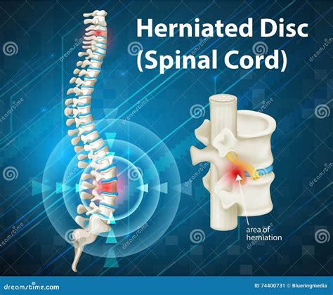 Diagram Showing Herniated Disc Illustration Stock Vector Image Art