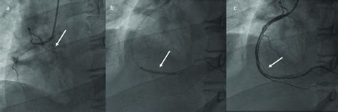 Plain Old Balloon Angioplasty Poba Of The Right Coronary Artery