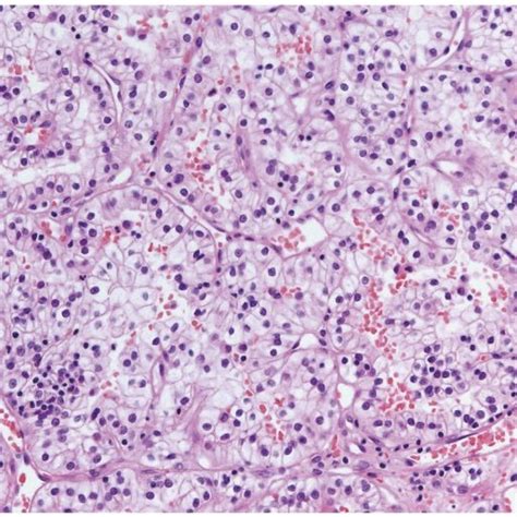 Clear Cell Renal Cell Carcinoma Showing Solid Nests Of Clear Cells