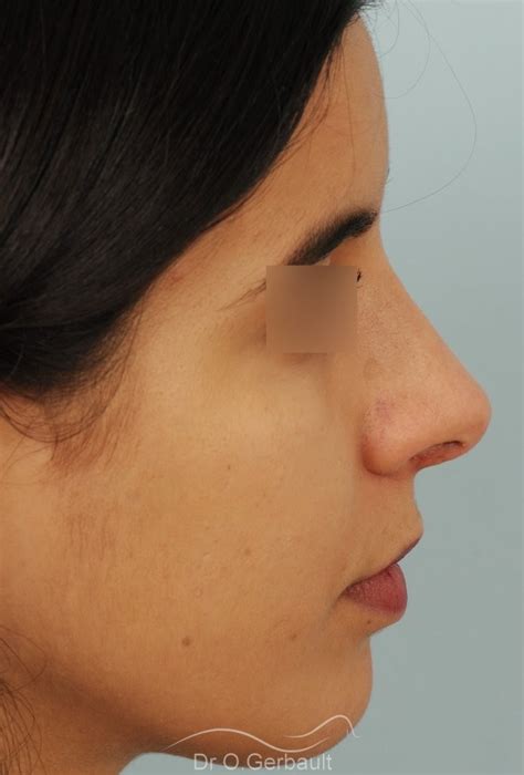 Photos De Rhinoplastie Avec Pointe De Nez Large Avant Et Apr S