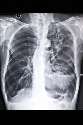 4 Stages Of Pulmonary Fibrosis