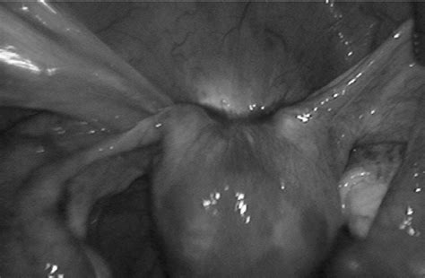 Right Ureteral Stenosis Due To Deep Infiltrating Endometriosis Whose