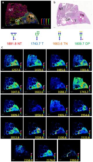 Maldi Imaging Mass Spectrometry Profiling Of N Glycans In Formalin Fixed Paraffin Embedded