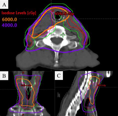 Dose Distribution A Axial B Coronal And C Sagittal Slices Showed The