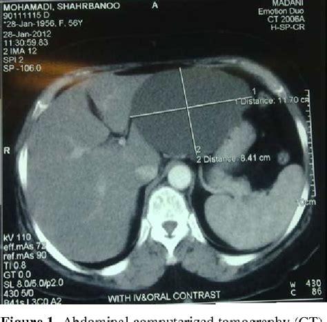 Figure 1 From A Patient With Cystic Lymphangioma In Pancreas Semantic