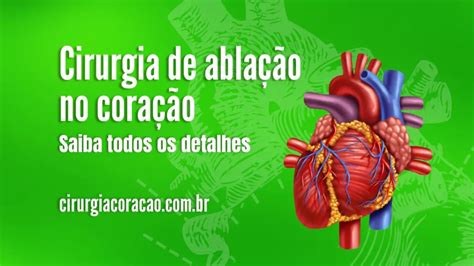 Cirurgia De Ablação No Coração Saiba Todos Os Detalhes