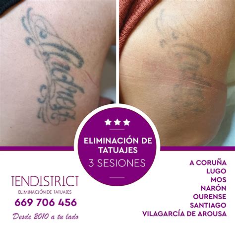 L Ser Para Quitar Tatuajes En A Coru A Tendistrict