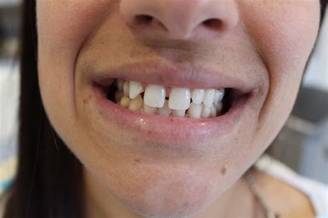 Invisalign Before And After Gap