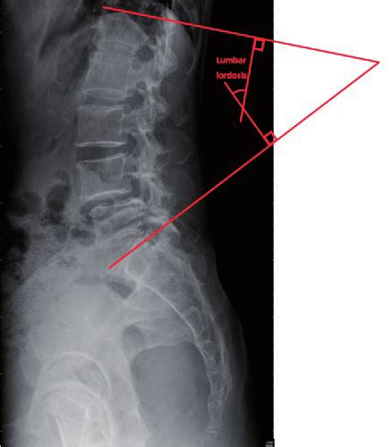 Spinopelvic Parameter Lumbar Lordosis Download Scientific Diagram