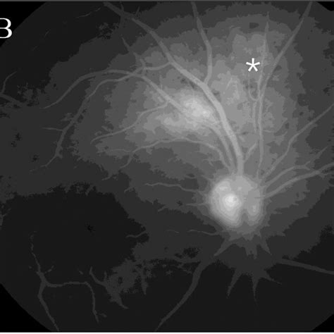 Early A And Late B Phases Of Fluorescein Angiography Showed Lesions Download Scientific