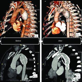 Computed Tomography Volume Rendering Technique VRT Top And Curved