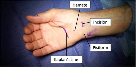 Placement of the incision. A 1-centimeter transverse incision is made ...