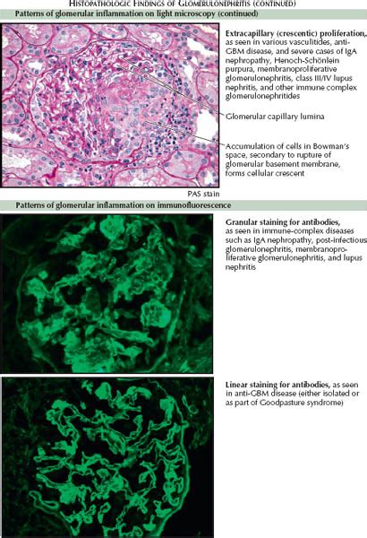 Membranoproliferative Glomerulonephritis Immunofluorescence