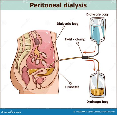 Peritoneal Dialysis. Renal Insufficiency. Vector Illustration