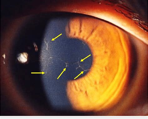 Figure 1 From A Case Of Herpetic Keratitis In An Orthokeratology