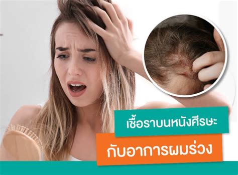 Fungal Scalp Infection Understanding Hair Loss Problem