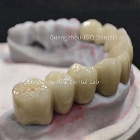 Full Arch Restorations Pfm Metal Coping Crowns With Glass Ceramics