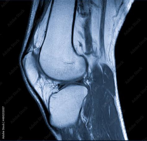 Magnetic Resonance Images Of The Knee Joint Sagittal Proton Density