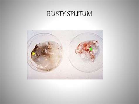 Rust Colored Sputum