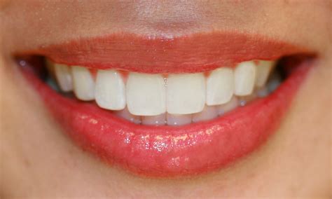 Bellevue Dentist Visits May Detect Early Tongue Disease