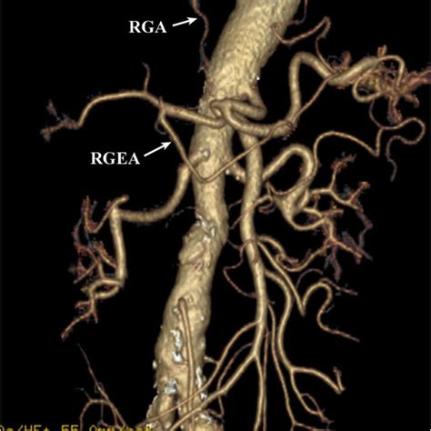 Preoperative 3 Dimensional Angiography Reconstructed From The Computed Download Scientific