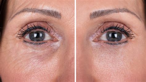 Elimina Las Ojeras Y Rejuvenece Tu Contorno De Ojos Sin Maquillaje 3