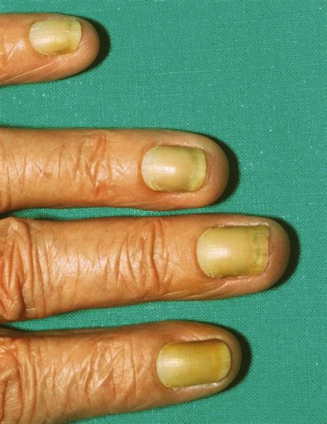 Yellow nail syndrome | Plastic Surgery Key