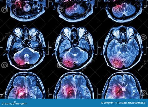 Filma Mri Kopiering F R Magnetisk Resonans Av Hj Rnan Slagl Ngden