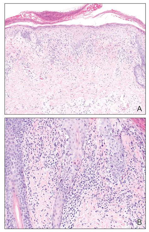 Crusted Papules On The Bilateral Helices And Lobules Mdedge Dermatology