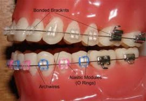 Braces Timeline Timetoast Timelines