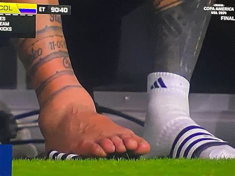 New Picture Shows Lionel Messi S Gruesome Ankle Injury That Left Him In