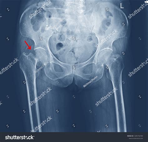 Xray Both Hip Fracture Proximal Femur Stock Photo 1285750780 | Shutterstock