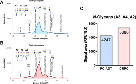 The difference in the serum N glycans on α 1 acid glycoprotein AGP