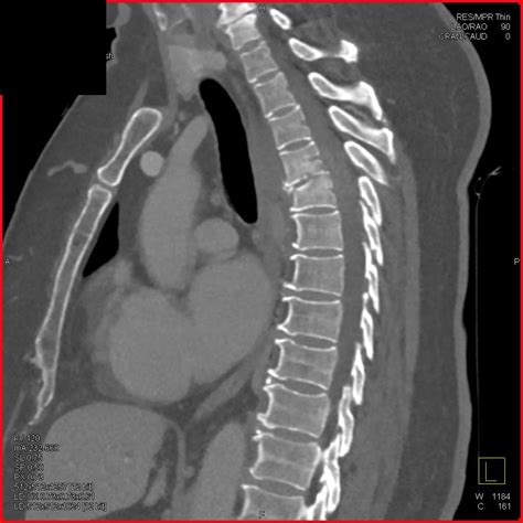 Osteomyelitis T Spine Musculoskeletal Case Studies Ctisus Ct Scanning