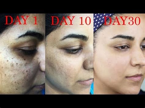 How do I get rid of dark scars, hyperpigmentation, acne/acne – Health