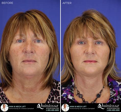 Mini Facelift Photos Milwaukee Patient 17336