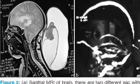 Figure From A Giant Occipital Encephalocele With Spontaneous