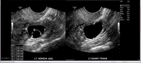 Daughter Cyst Ultrasound