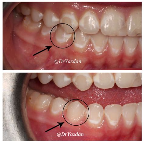 How To Get Rid Of Clear Teeth - TeethWalls