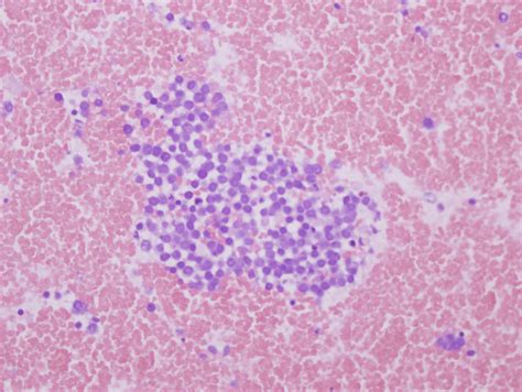 Pathology Outlines Merkel Cell Carcinoma